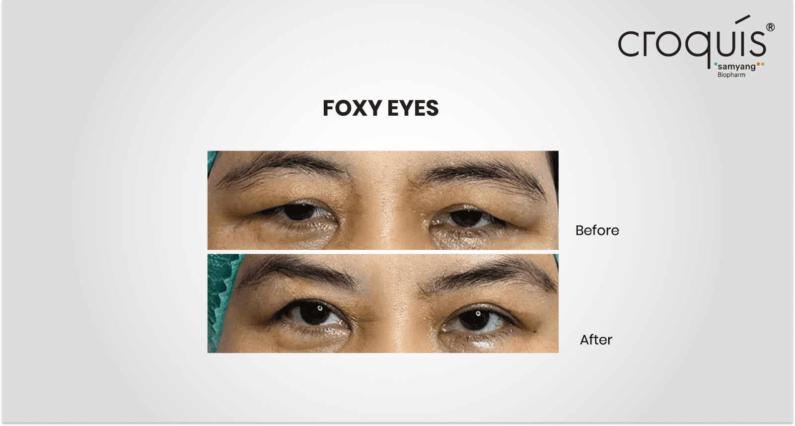 foxy eyes lift