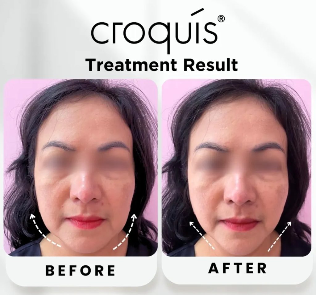 thread lift pipi