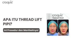 thread lift pipi