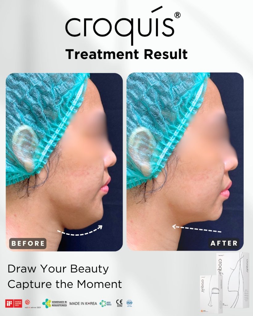 cara menghilangkan double chin dalam 3 hari​
