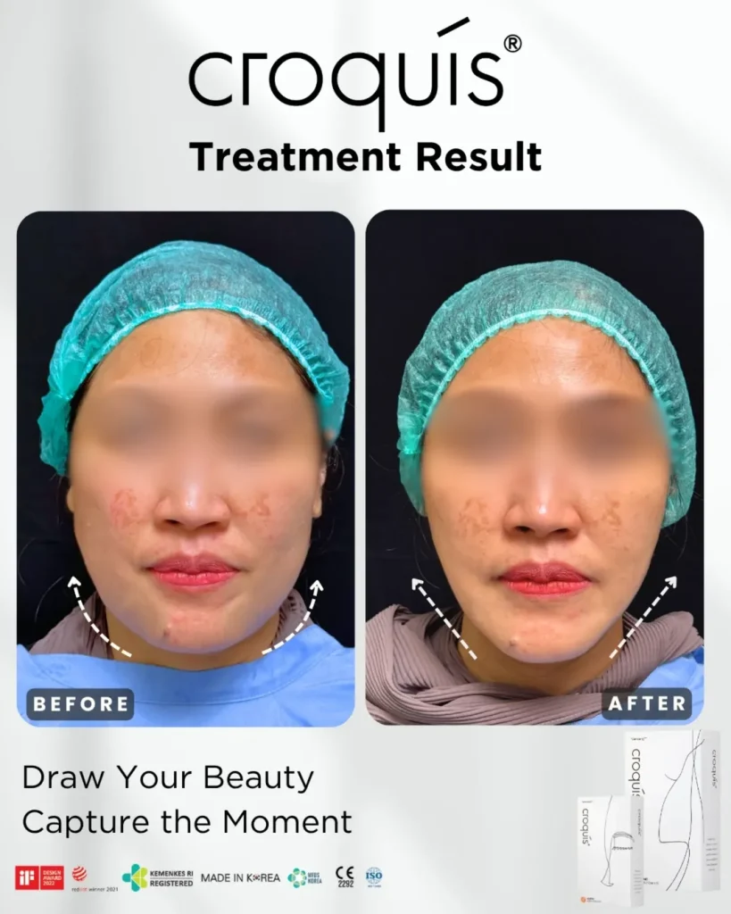 cara mengencangkan kulit wajah yang kendur